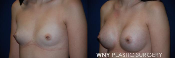 Before & After Breast Augmentation Case 75 View #3 View in Buffalo, NY