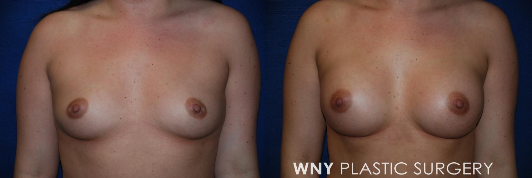 Before & After Breast Augmentation Case 76 View #1 View in Williamsville, NY