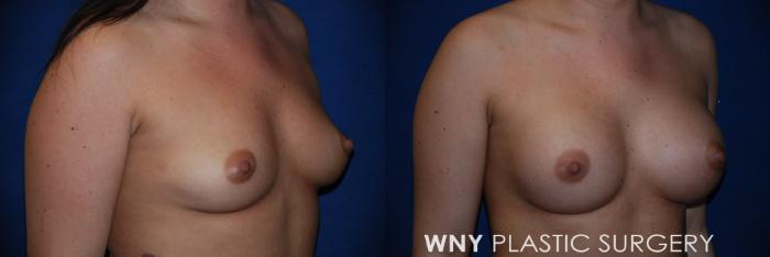 Before & After Breast Augmentation Case 76 View #2 View in Buffalo, NY