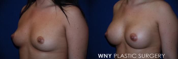 Before & After Breast Augmentation Case 76 View #3 View in Buffalo, NY