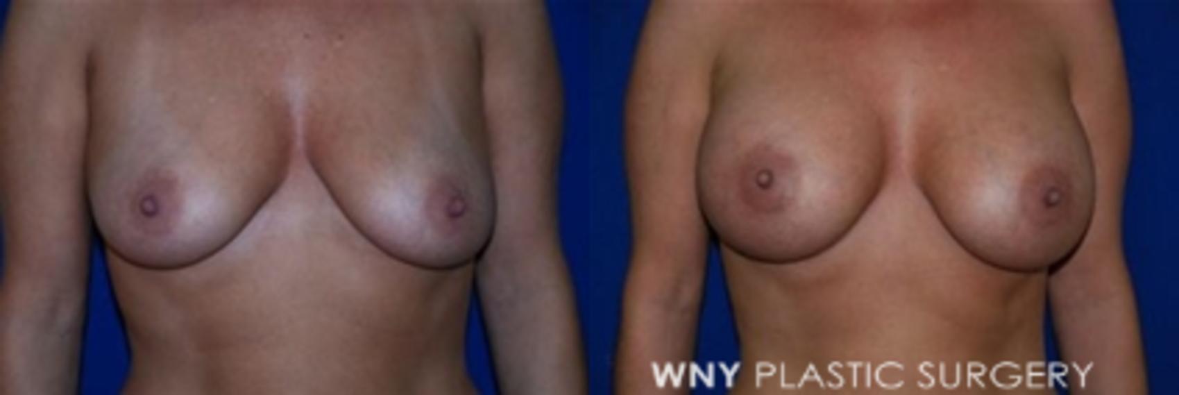 Before & After Breast Augmentation Case 8 View #1 View in Buffalo, NY