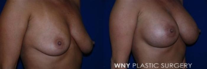 Before & After Breast Augmentation Case 8 View #2 View in Williamsville, NY
