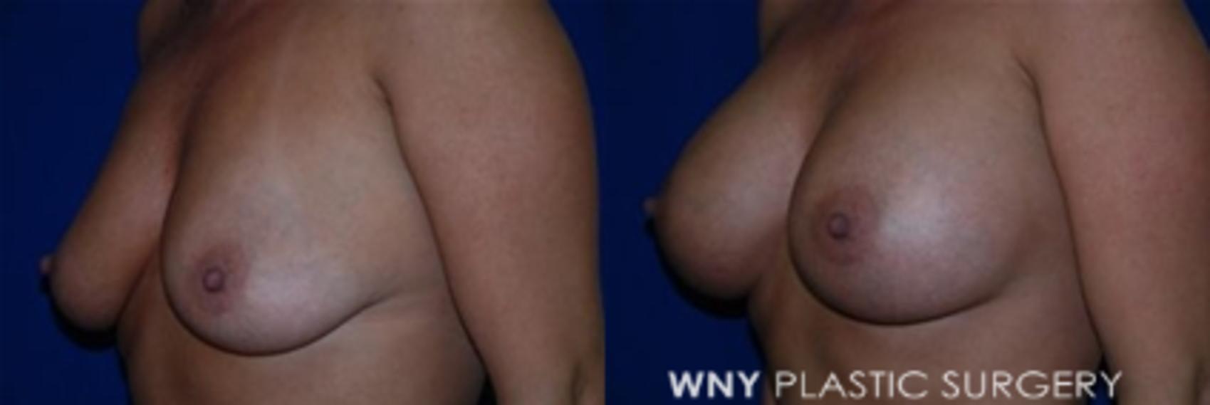 Before & After Breast Augmentation Case 8 View #3 View in Williamsville, NY