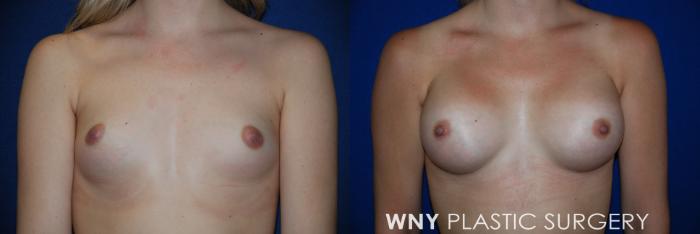 Before & After Breast Augmentation Case 81 View #1 View in Buffalo, NY