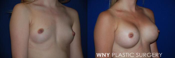 Before & After Breast Augmentation Case 81 View #2 View in Buffalo, NY