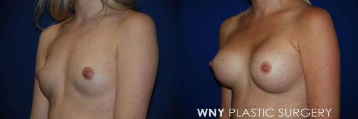 Before & After Breast Augmentation Case 81 View #3 View in Buffalo, NY