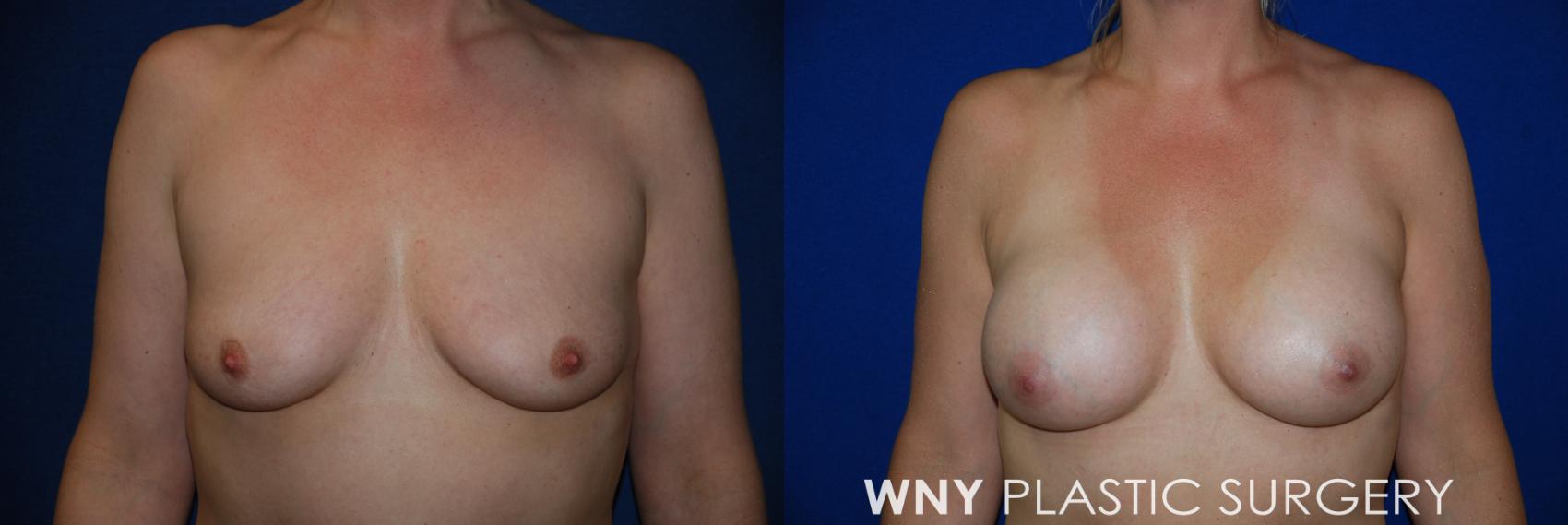 Before & After Breast Augmentation Case 83 View #1 View in Buffalo, NY