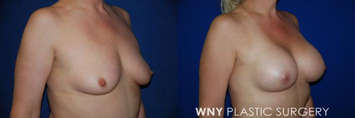 Before & After Breast Augmentation Case 83 View #2 View in Buffalo, NY