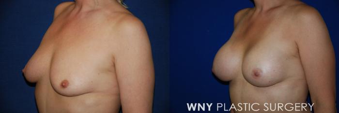 Before & After Breast Augmentation Case 83 View #3 View in Buffalo, NY