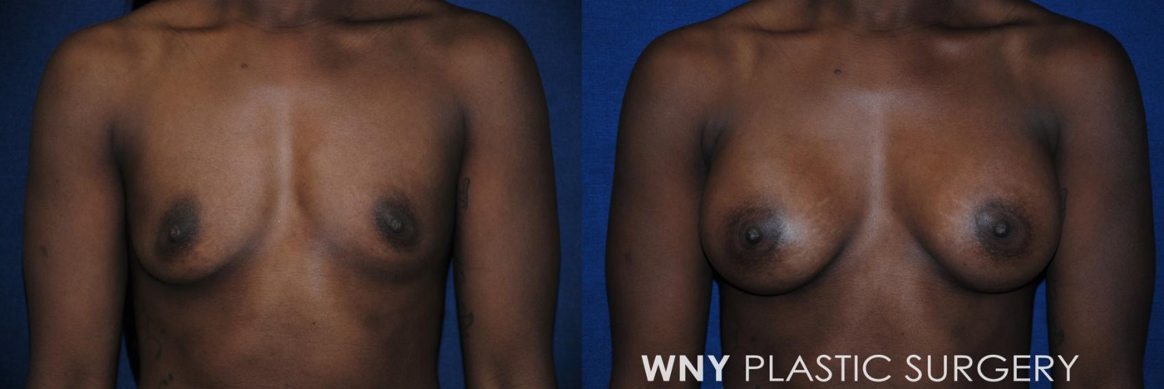 Before & After Breast Augmentation Case 84 View #1 View in Williamsville, NY