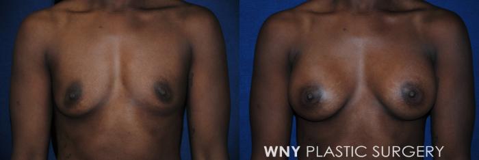 Before & After Breast Augmentation Case 84 View #1 View in Buffalo, NY