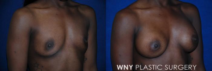 Before & After Breast Augmentation Case 84 View #2 View in Buffalo, NY