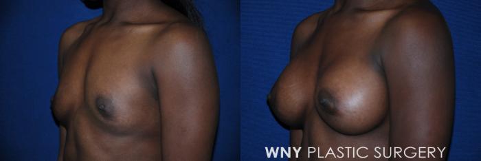Before & After Breast Augmentation Case 84 View #3 View in Buffalo, NY