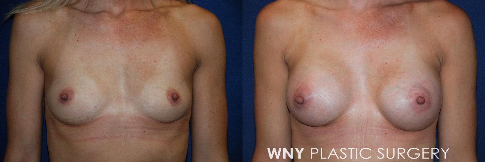 Before & After Breast Augmentation Case 85 View #1 View in Williamsville, NY