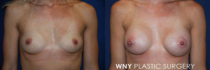 Before & After Breast Augmentation Case 85 View #1 View in Buffalo, NY