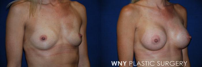 Before & After Breast Augmentation Case 85 View #2 View in Buffalo, NY