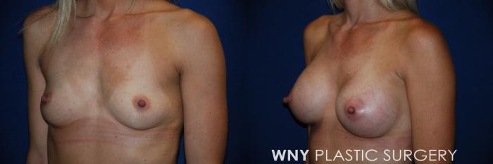 Before & After Breast Augmentation Case 85 View #3 View in Buffalo, NY