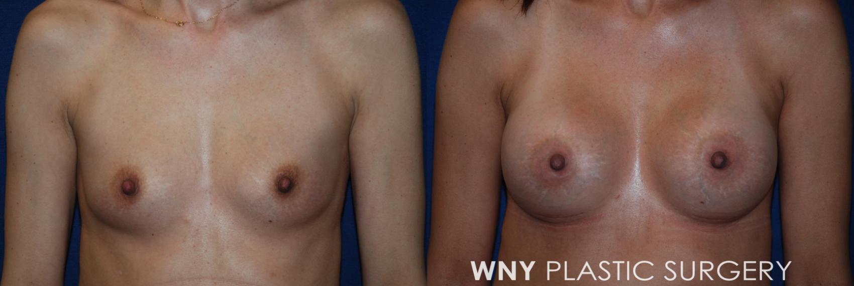 Before & After Breast Augmentation Case 86 View #1 View in Williamsville, NY