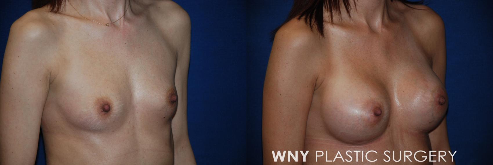 Before & After Breast Augmentation Case 86 View #2 View in Williamsville, NY