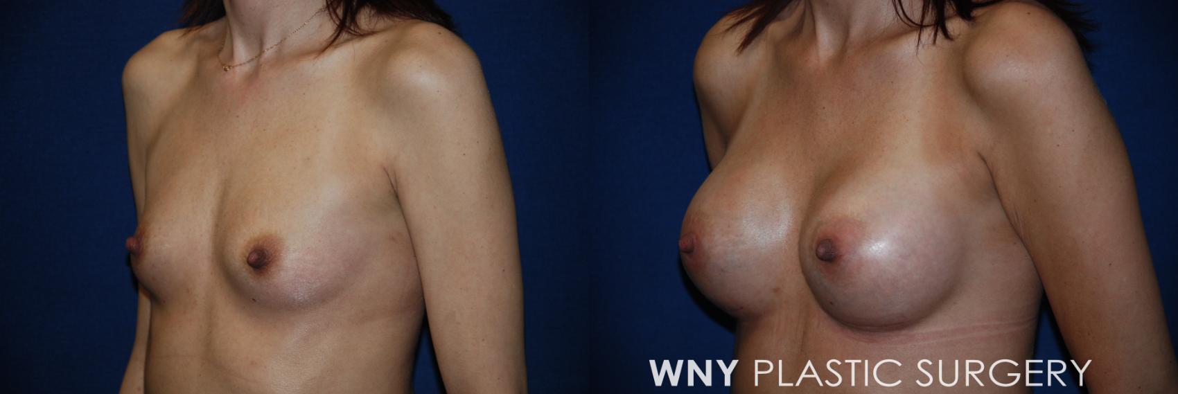 Before & After Breast Augmentation Case 86 View #3 View in Williamsville, NY
