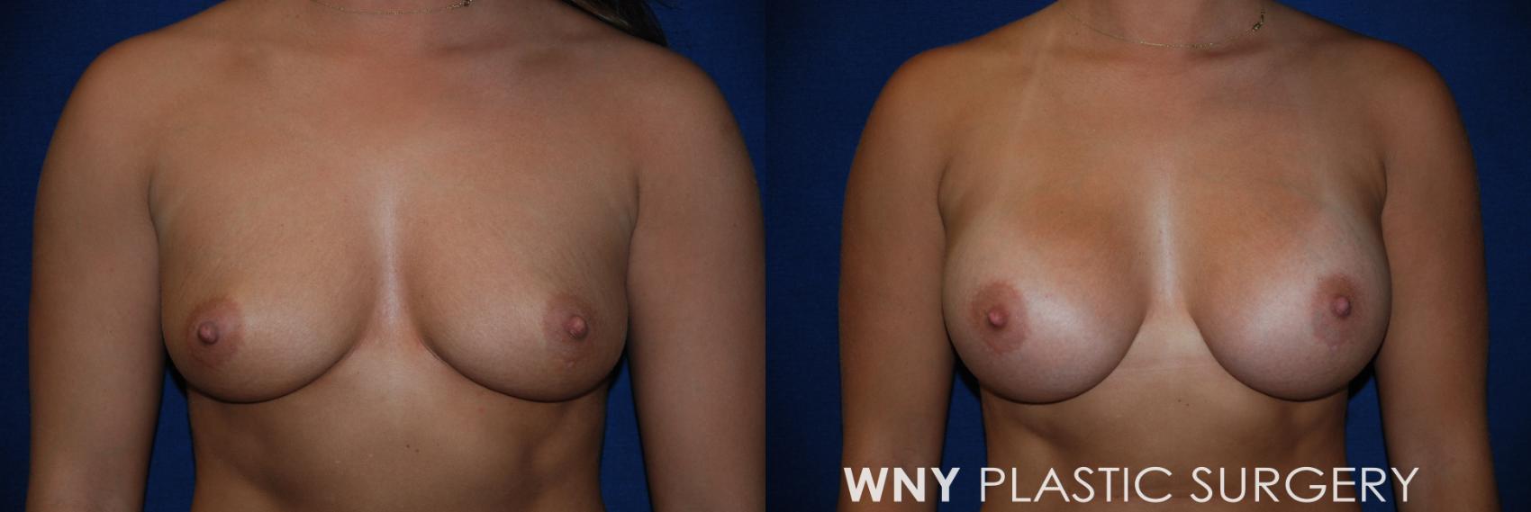Before & After Breast Augmentation Case 89 View #1 View in Williamsville, NY