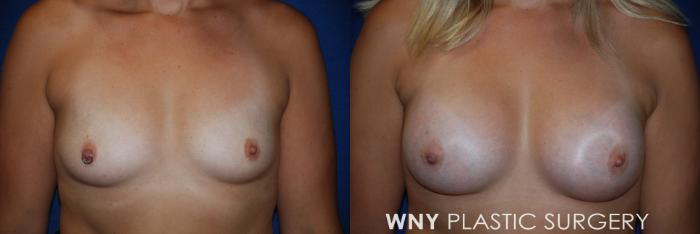 Before & After Breast Augmentation Case 94 View #1 View in Williamsville, NY