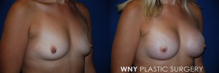 Before & After Breast Augmentation Case 94 View #2 View in Williamsville, NY