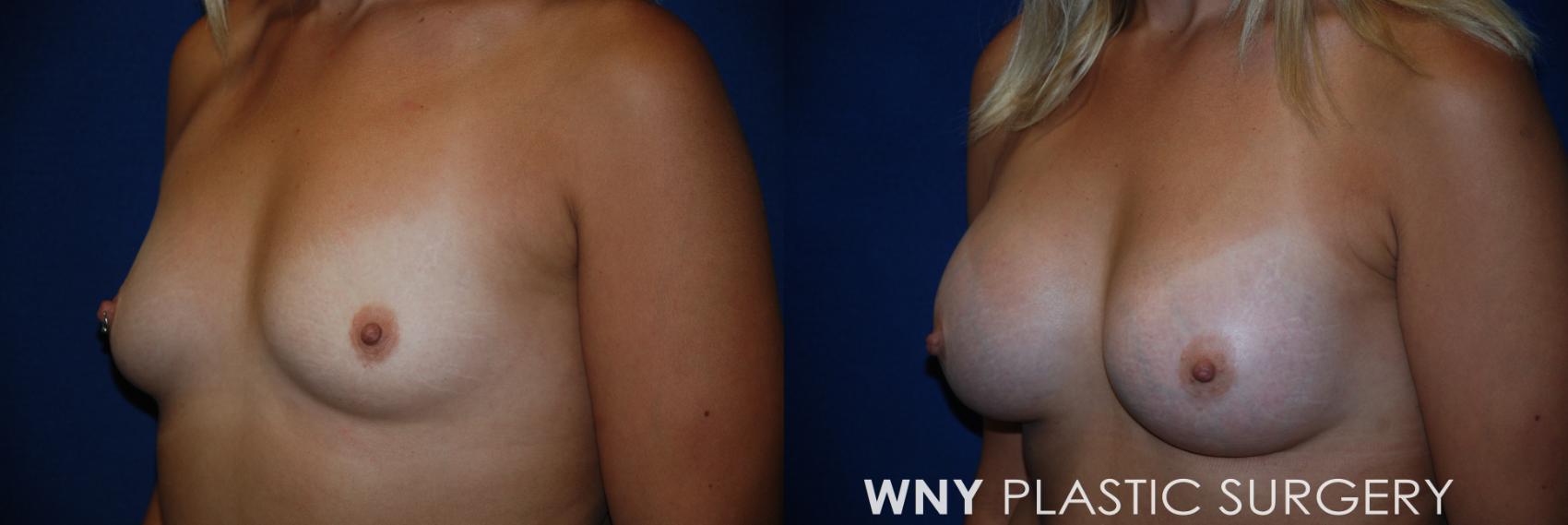 Before & After Breast Augmentation Case 94 View #3 View in Williamsville, NY