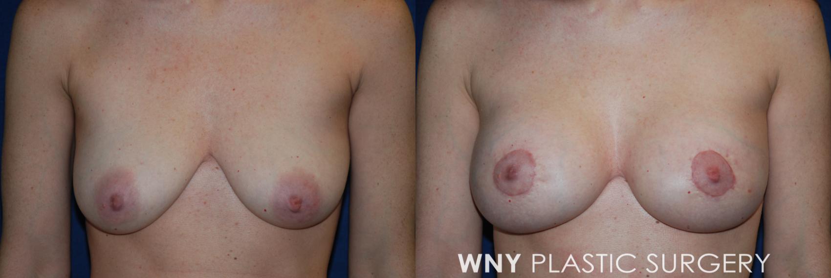 Before & After Breast Augmentation & Mini Lift Case 168 Front View in Buffalo, NY