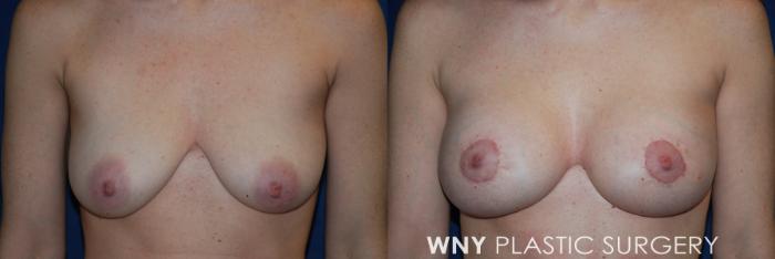 Before & After Breast Augmentation & Mini Lift Case 168 Front View in Williamsville, NY