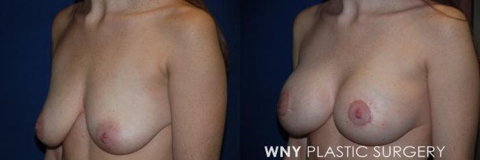 Before & After Breast Augmentation & Mini Lift Case 168 Left Oblique View in Buffalo, NY