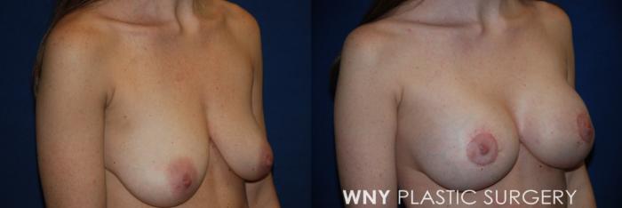 Before & After Breast Augmentation & Mini Lift Case 168 Right Oblique View in Buffalo, NY