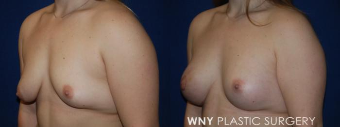 Before & After Breast Augmentation Case 197 Left Oblique View in Buffalo, NY