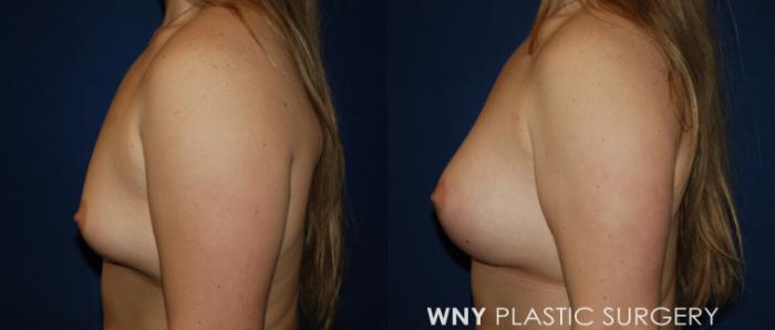 Before & After Breast Augmentation Case 197 Left Side View in Buffalo, NY