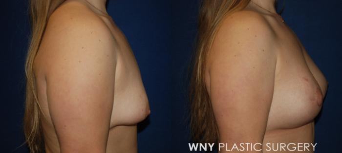 Before & After Breast Augmentation & Mini Lift Case 197 Right Side View in Williamsville, NY