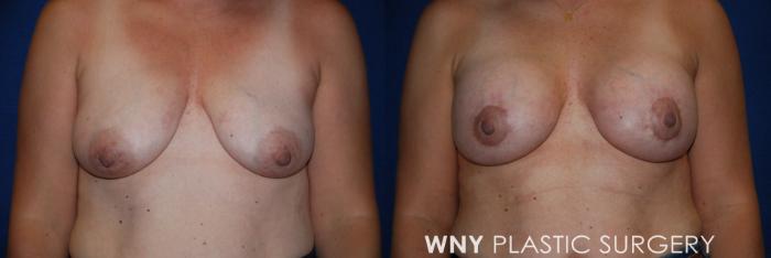 Before & After Breast Lift Case 202 Front View in Williamsville, NY