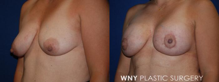 Before & After Breast Augmentation Case 202 Left Oblique View in Buffalo, NY