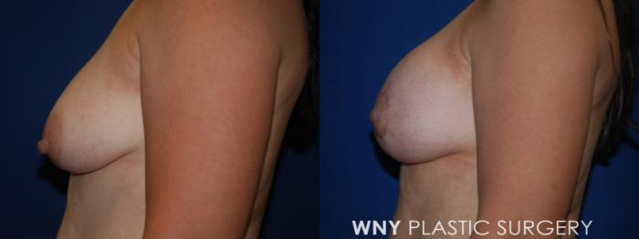 Before & After Breast Augmentation & Mini Lift Case 202 Left Side View in Buffalo, NY