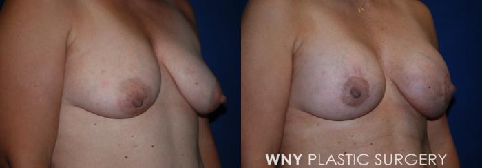 Before & After Breast Augmentation & Mini Lift Case 202 Right Oblique View in Buffalo, NY