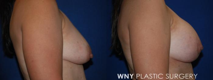 Before & After Breast Augmentation Case 202 Right Side View in Buffalo, NY
