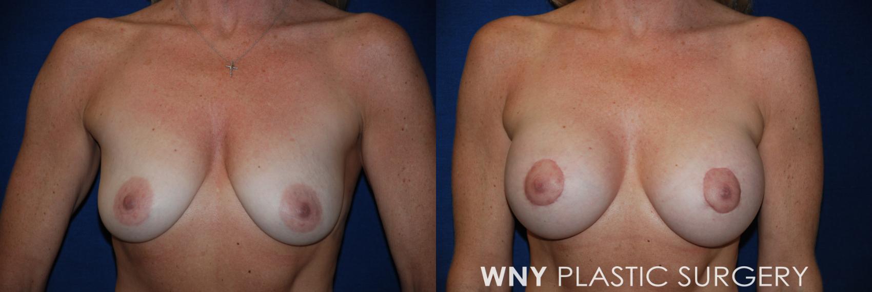 Before & After Breast Augmentation & Mini Lift Case 21 View #1 View in Williamsville, NY