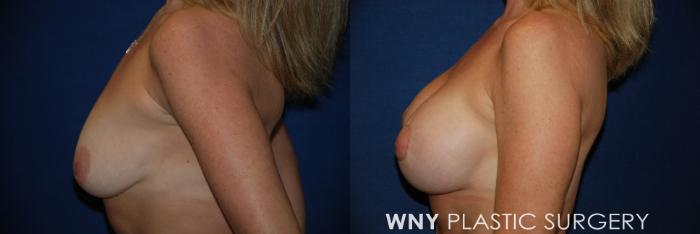 Before & After Breast Augmentation & Mini Lift Case 21 View #2 View in Buffalo, NY