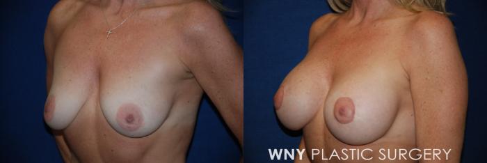 Before & After Breast Augmentation & Mini Lift Case 21 View #3 View in Buffalo, NY