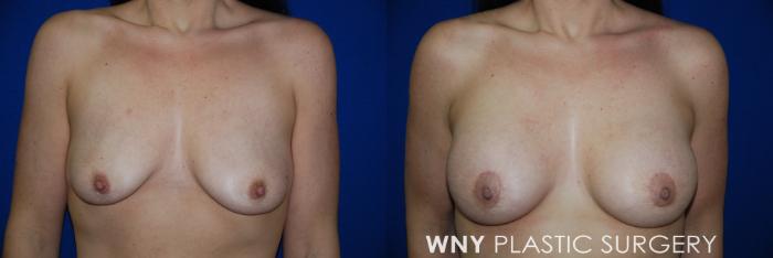 Before & After Breast Augmentation & Mini Lift Case 39 View #1 View in Williamsville, NY