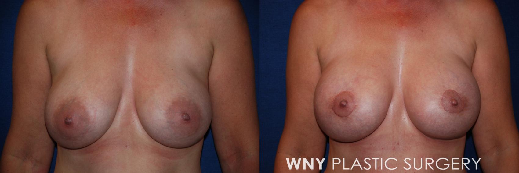 Before & After Breast Augmentation & Mini Lift Case 44 View #1 View in Buffalo, NY