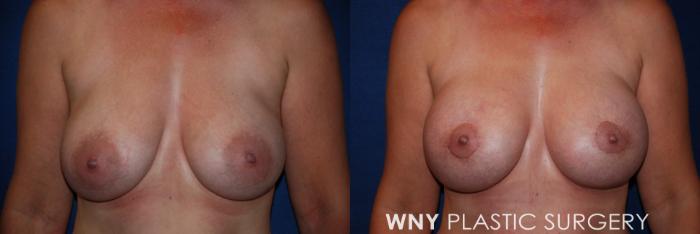 Before & After Breast Augmentation & Mini Lift Case 44 View #1 View in Williamsville, NY