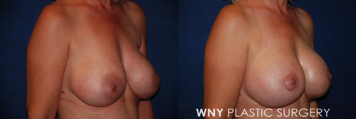 Before & After Breast Augmentation & Mini Lift Case 44 View #2 View in Buffalo, NY