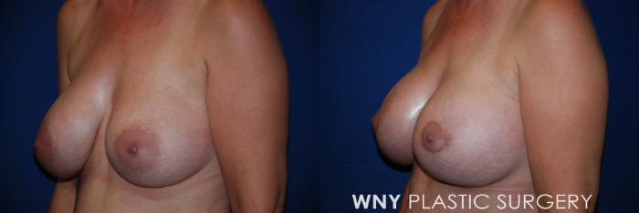 Before & After Breast Augmentation & Mini Lift Case 44 View #3 View in Buffalo, NY