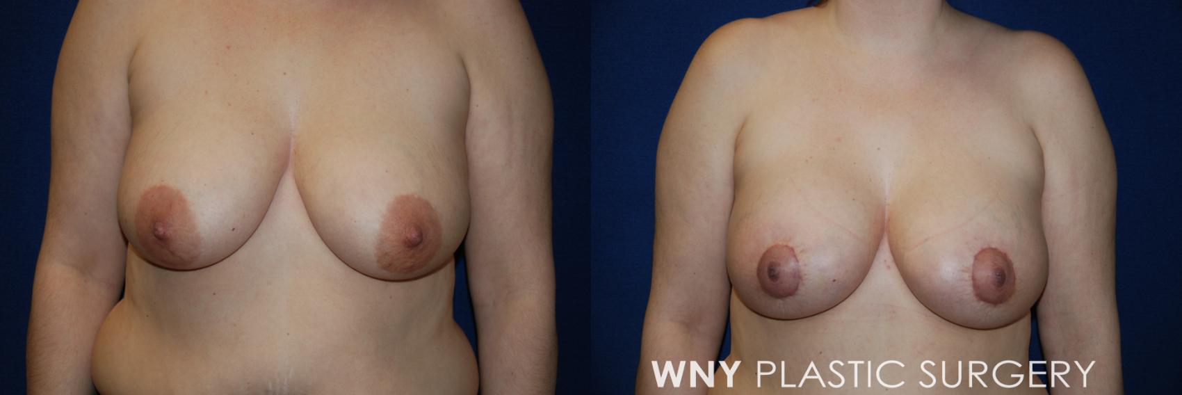 Before & After Breast Augmentation & Mini Lift Case 55 View #1 View in Williamsville, NY