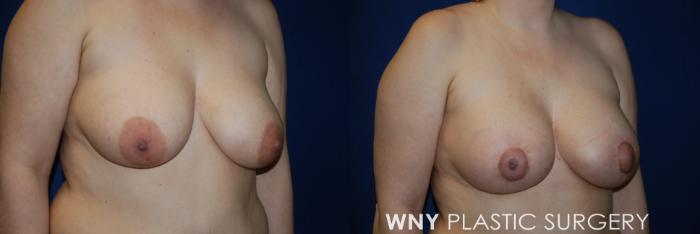 Before & After Breast Augmentation & Mini Lift Case 55 View #2 View in Buffalo, NY